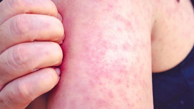 Measles Case Confirmed in South Carolina Upstate Region, Health Officials Urge Vaccination