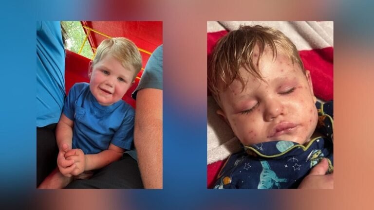 2-Year-Old Georgia Child in ICU After Stung by Yellow Jackets Over 150 Times