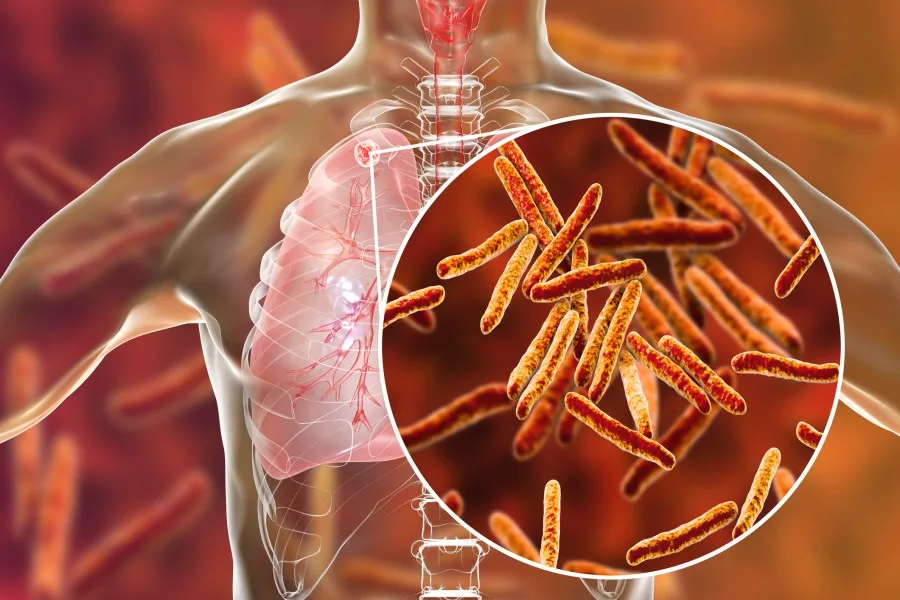 New Tuberculosis Case Confirmed in Macon County, North Carolina as State Monitors Growing Concern