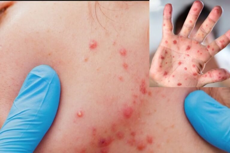 Georgia DPH Confirms Three New Measles Cases Linked to Fulton County Outbreak