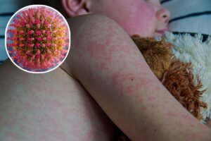Measles Cases Rise in South Carolina and Michigan as U.S. Total Reaches 1,563
