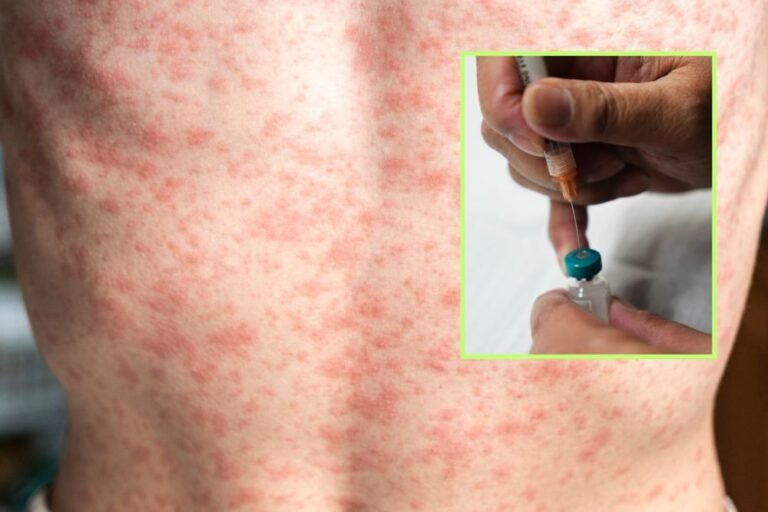Measles Outbreak Confirmed in Upstate South Carolina, Eight Cases Reported
