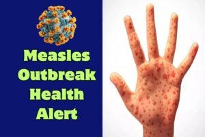 Health Alert: Measles Outbreak Reported in Upstate South Carolina, Officials Urge Immediate Vaccination
