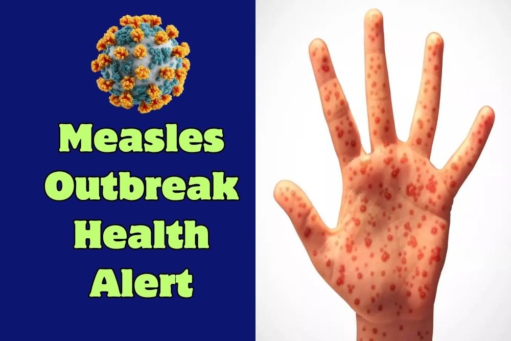Health Alert: Measles Outbreak Reported in Upstate South Carolina, Officials Urge Immediate Vaccination