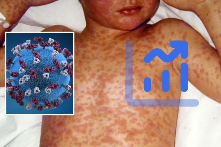 Measles Outbreak in South Carolina