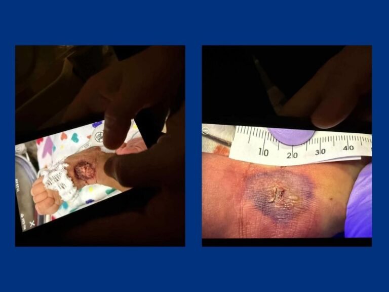 Kansas City Mother Accuses St. Luke’s Hospital of Neglect After Newborn Suffers Severe IV Injury